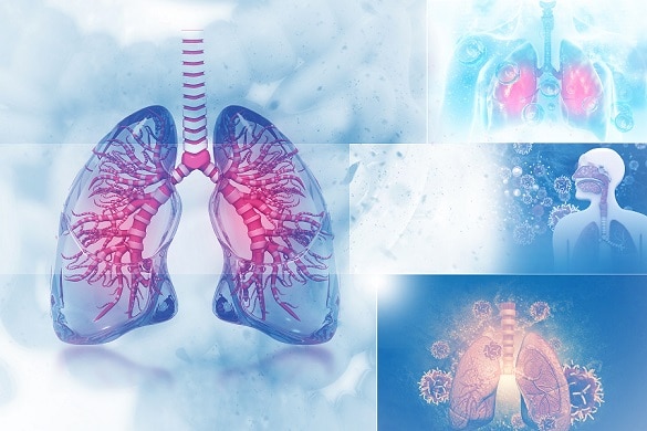 Asthma and Exercise