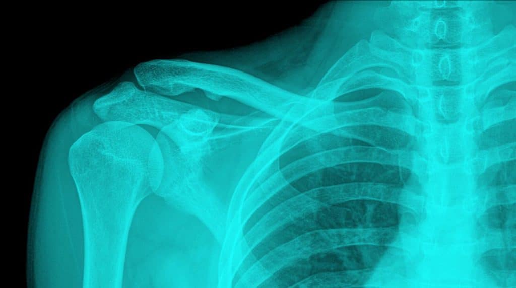 Osteoarthritis