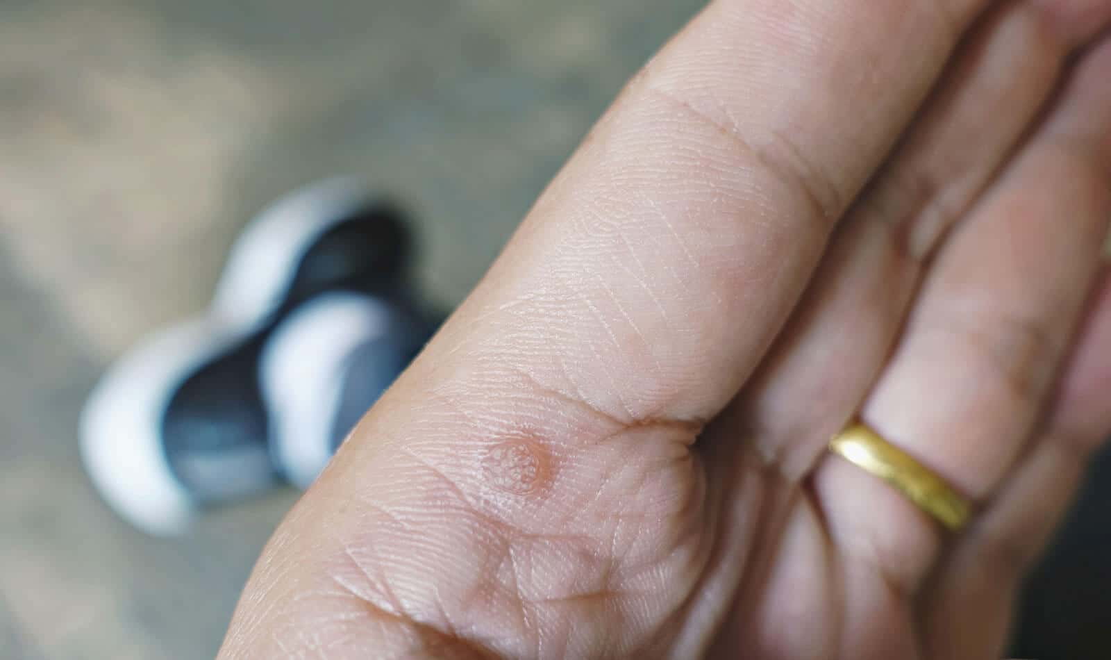 Corns and Calluses
